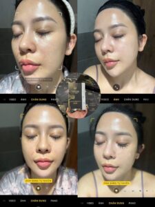 Sự thay đổi khi tiêm karisma