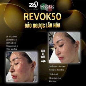 Trước và sau khi sử dụng Revok 50