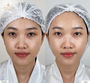 Revok 50 – Skinbooster tái sinh làn da đa tầng