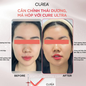 Khách hàng sử dụng Filler Curea