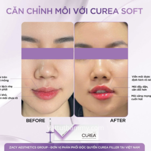 Khách hàng sử dụng Filler Curea
